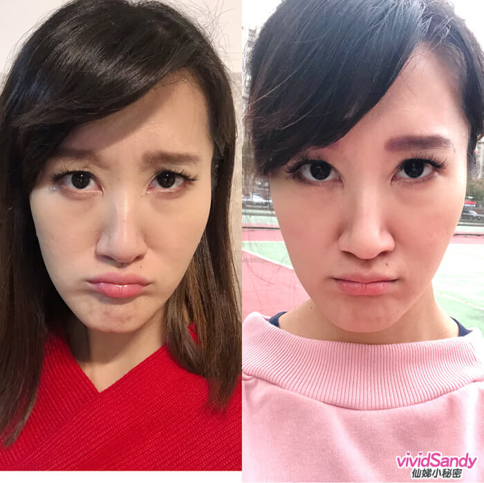 悠美醫美 肉毒桿菌 比較