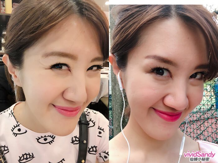 悠美醫美 肉毒桿菌 比較